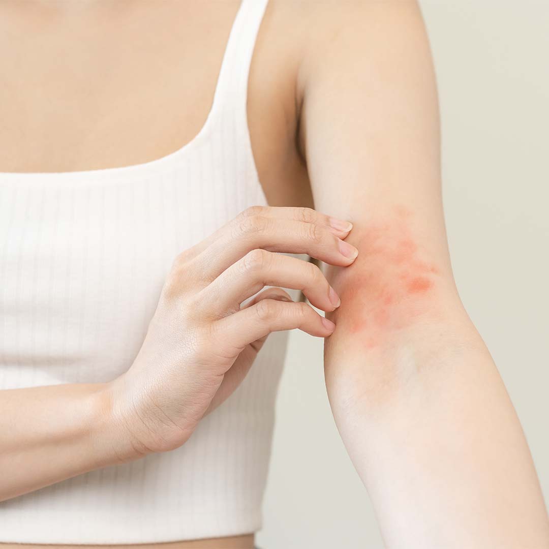 皮膚敏感粒粒痕好難頂？AQ BIO草本配方幫你預防及治療皮膚敏感