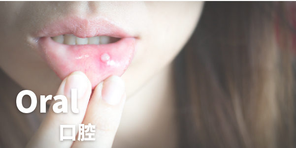 口腔問題,AQ Bio消毒殺菌噴霧、殺菌達99.9999%, 對抗濕疹,暗瘡,皮膚敏感,念珠菌,鼻敏感,喉嚨痛, 助皮膚修護細胞, 產生抗菌能